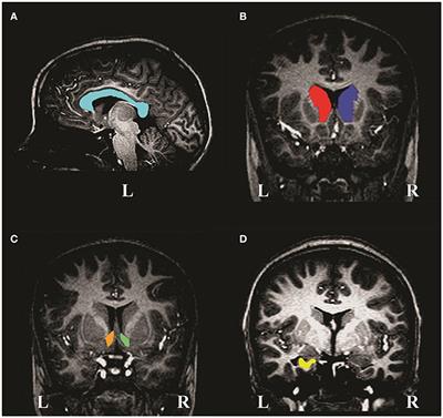 Reductions in Corpus Callosum Volume Partially Mediate Effects of Prenatal Alcohol Exposure on IQ